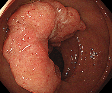 内視鏡で見た大腸がん