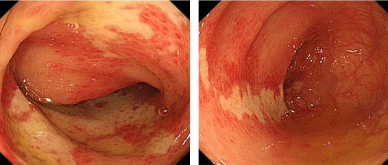 大腸内視鏡検査でみた虚血性大腸炎の病変部