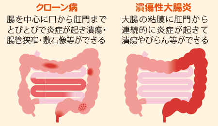 炎症性腸疾患である「クローン病」と「潰瘍性大腸炎」の説明